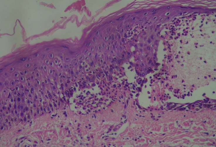 Un'età superiore ai 70 e il cancro della pelle sono risultati essere due fattori di rischio significativi per lo sviluppo di pemfigoide bolloso