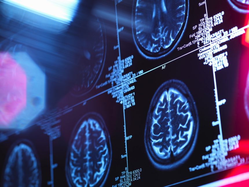 La neuroradiologia studia il sistema nervoso centrale e gli organi di senso: dall'Alzheimer alla sclerosi multipla, il contributo della ricerca