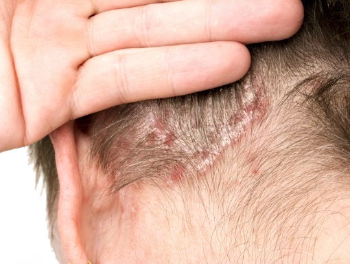 Negli adulti e adolescenti con psoriasi del cuoio capelluto, il trattamento topico una volta al giorno con la schiuma a base di roflumilast allo 0,3% si è dimostrata efficace