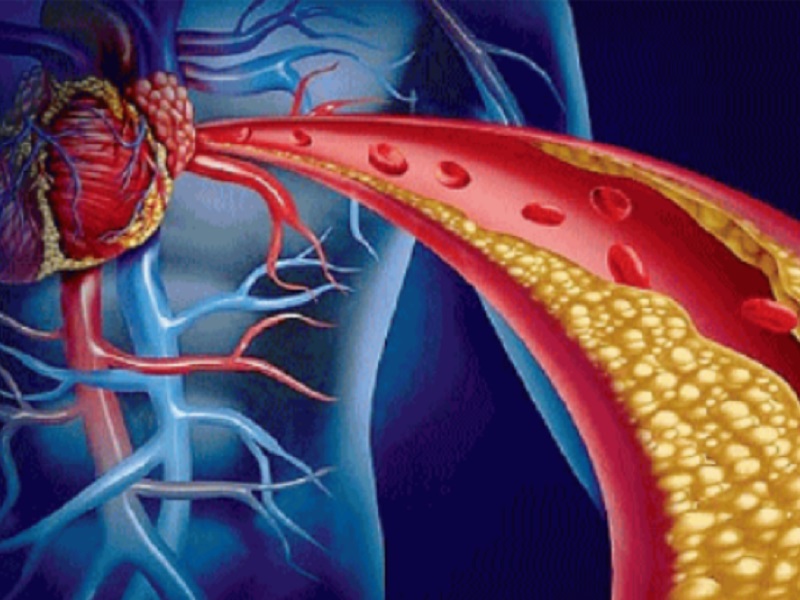 Lerodalcibep, inibitore di PCSK9 di terza generazione, può ridurre i livelli di colesterolo LDL del 56% in più in pazienti ad alto rischio di malattie cardiovascolari