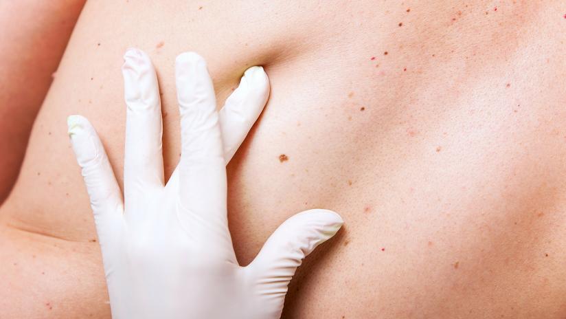 Studio sul melanoma spesso: in Italia cresce la sopravvivenza a 5 anni grazie all’uso comune di nuovi farmaci per la terapia mirata e per l’immunoterapia