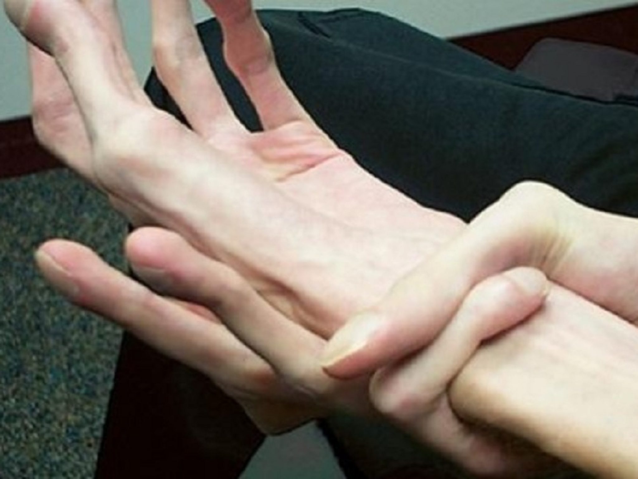 Преобладающая рука. Синдром Марфана (арахнодактилия). Арахнодактилия паучьи пальцы. Паучьи пальцы синдром Марфана. Длинные пальцы синдром Марфана.