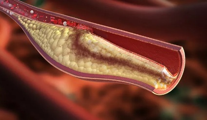 Gli acidi grassi omega-3 contrastano l'infiammazione e riducono l'aterosclerosi secondo uno studio del Karolinska Institutet