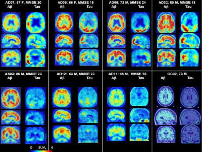 Alzheimer: ecco perché colpisce di più le donne. La riduzione del livello degli estrogeni associata alla menopausa è un fattore di rischio