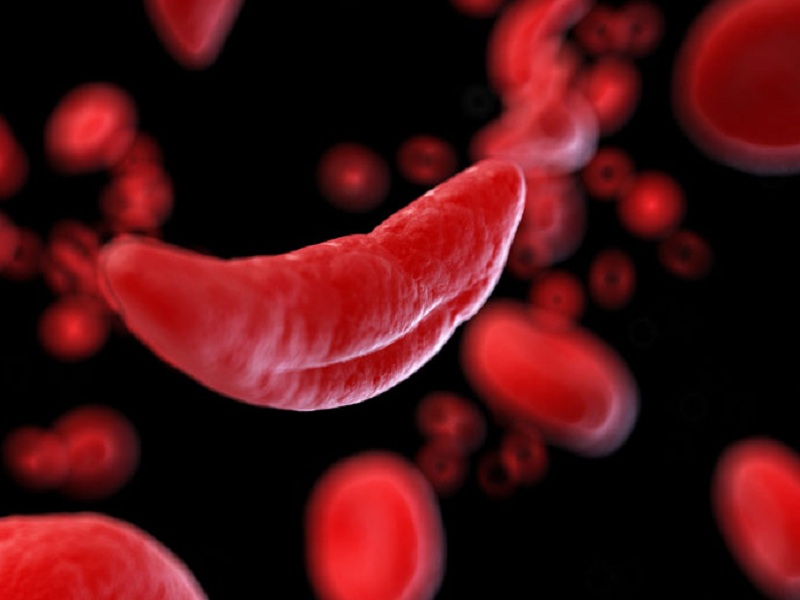 Anemia falciforme: via libera a crizanlizumab