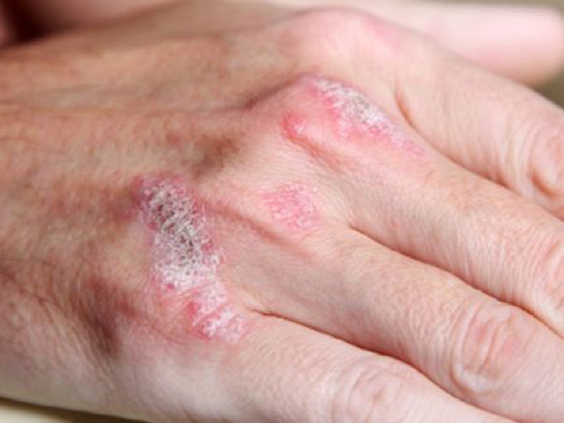 Artrite psoriasica: secondo un nuovo studio le articolazioni tumefatte sono l'indicatore migliore di sinovite rispetto a quelle che provocano dolore