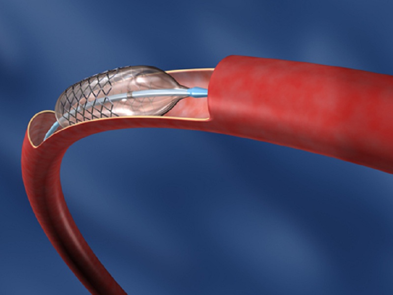 Stent post-infarto: monoterapia con ticagrelor riduce sanguinamento