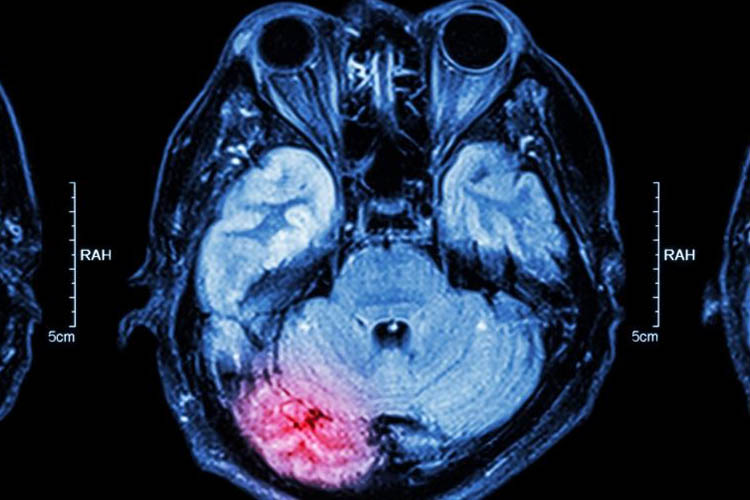 Tac di cervello con ictus da occlusione di vasi