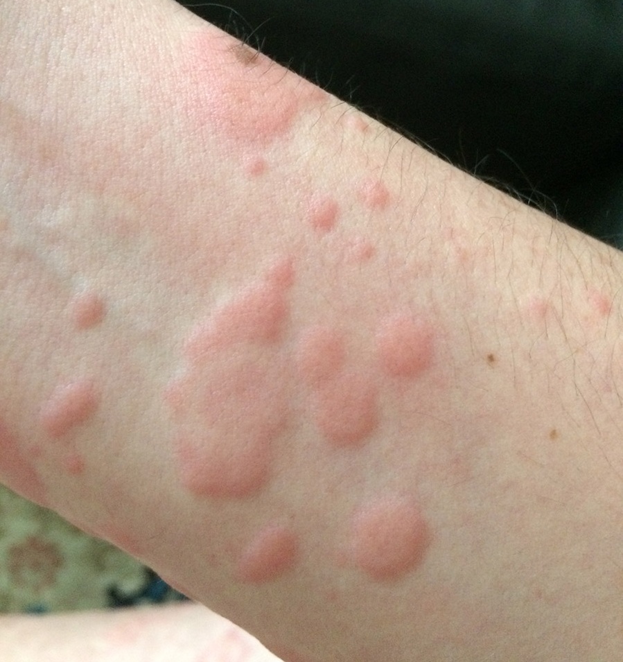 Orticaria cronica