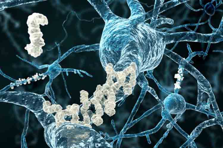 Alzheimer: i pazienti trattati con 2 o 3 mg di brexpiprazolo hanno mostrato un miglioramento statisticamente significativo nel ridurre i sintomi dell'agitazione