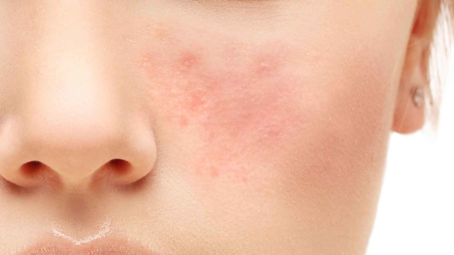 rosacea farmaci