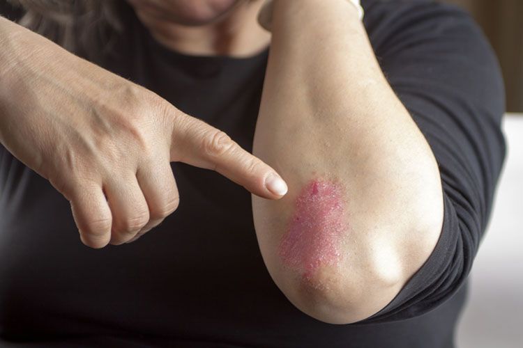 Psoriasi a placche e dermatite atopica: stop a lesioni e prurito con le nuove terapie