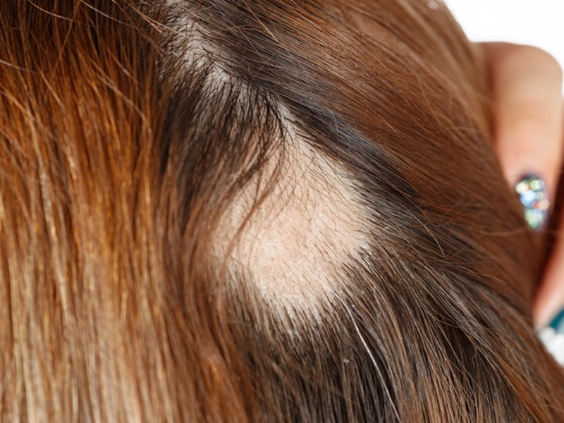 alopecia areata